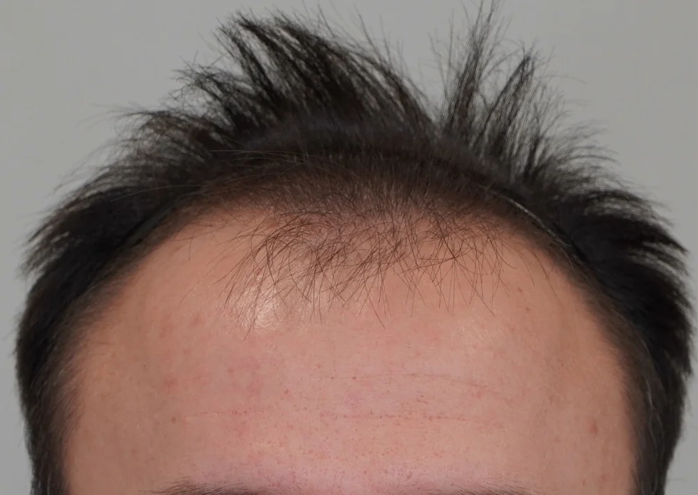 Before hair restoration: Male patient underwent FUE procedure of 1551 grafts.