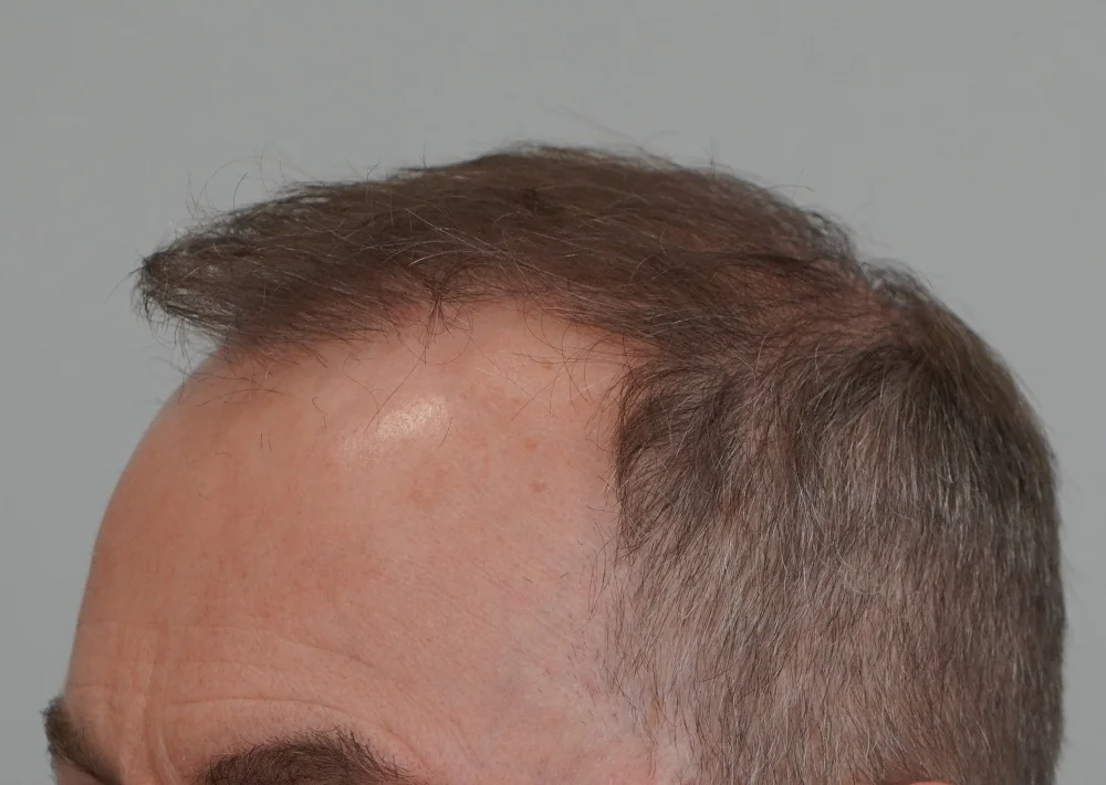 After hair restoration: Male patient underwent FUE procedure of 3904 grafts.
