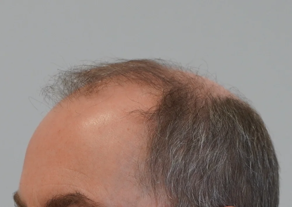 Before hair restoration: Male patient underwent FUE procedure of 3904 grafts.