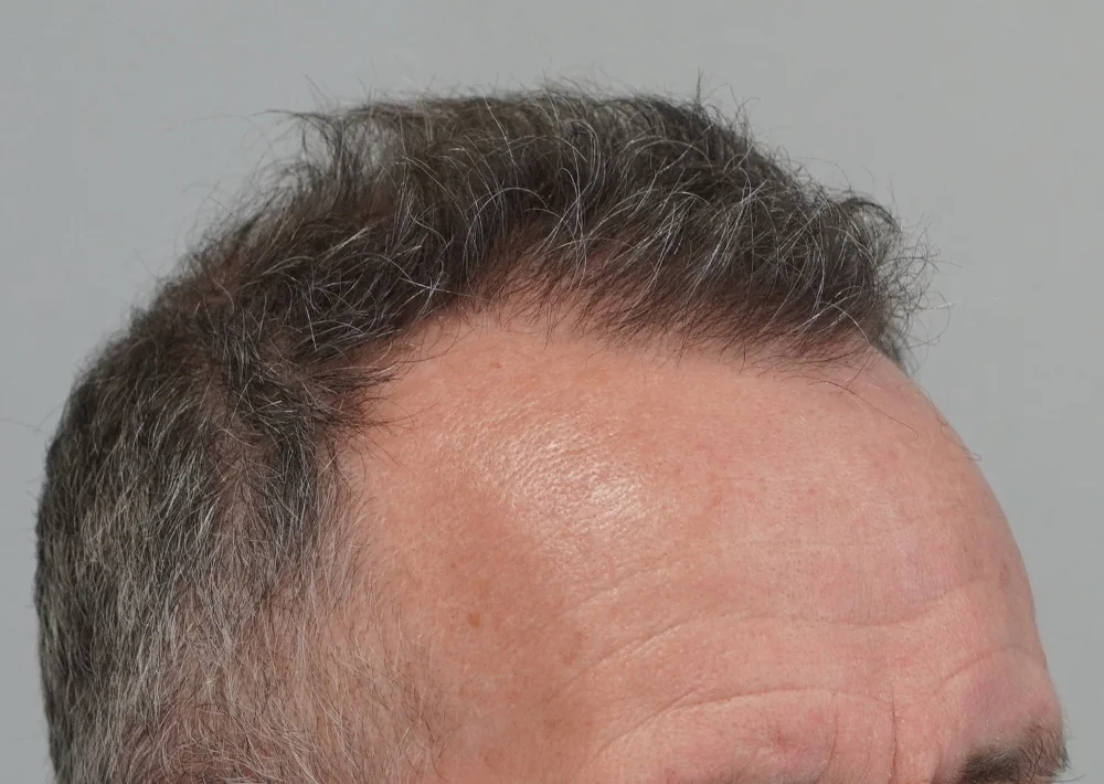 After hair restoration: Male patient underwent FUE procedure of 1628 grafts.