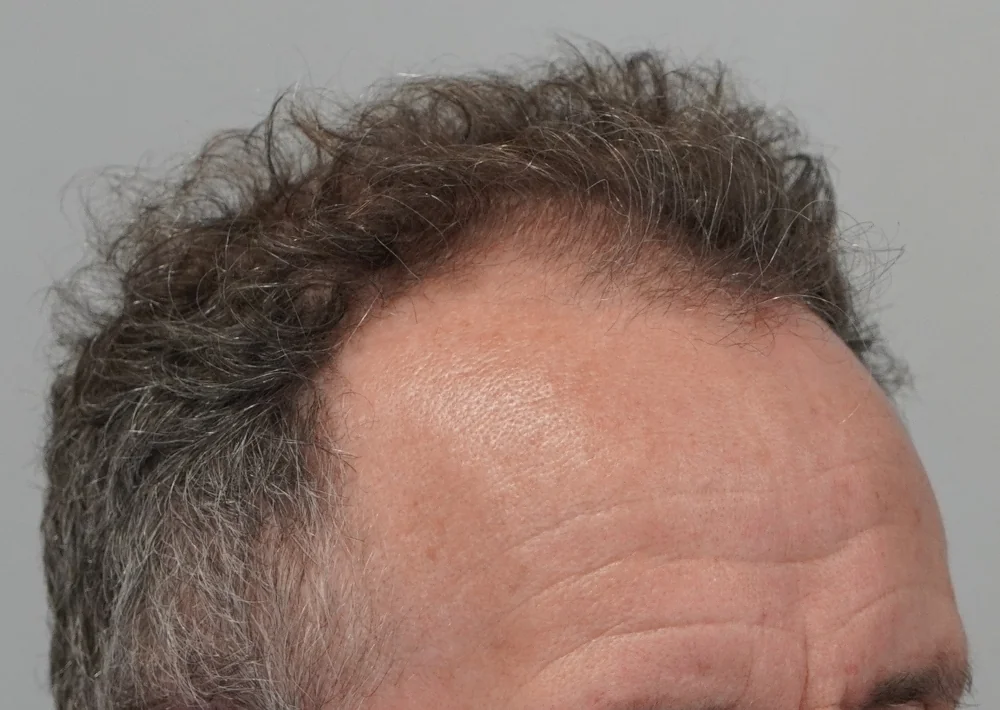 Before hair restoration: Male patient underwent FUE procedure of 1628 grafts.