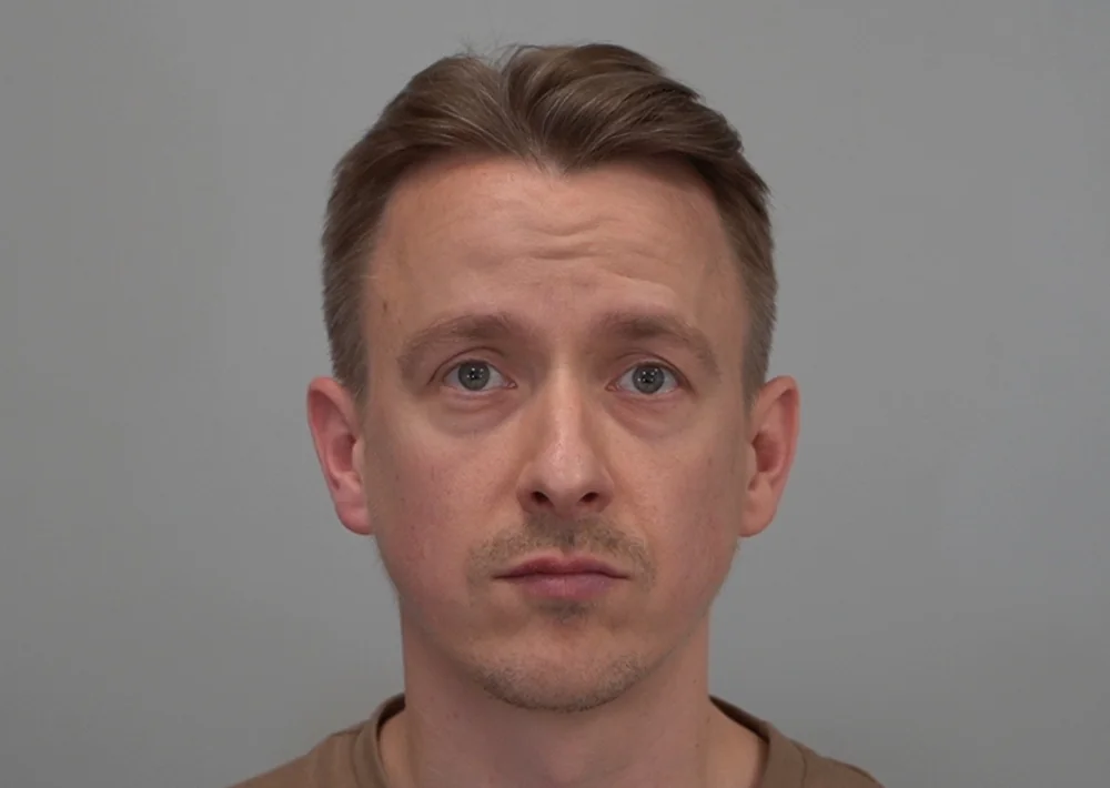After hair restoration: Male patient underwent FUE procedure of 1802 grafts.