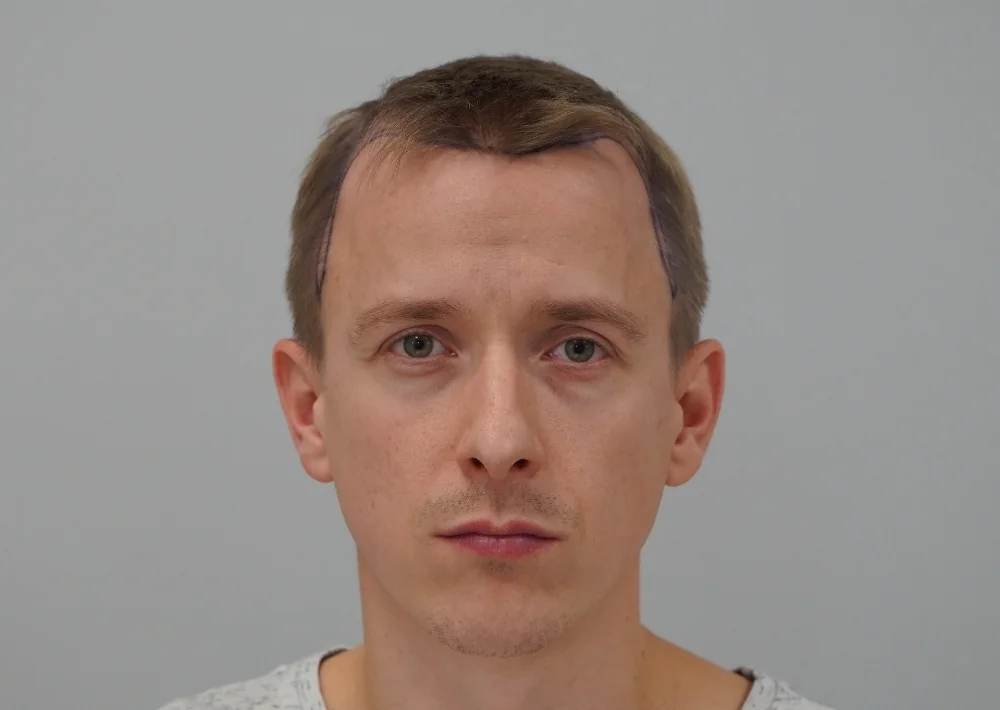 Before hair restoration: Male patient underwent FUE procedure of 1802 grafts.