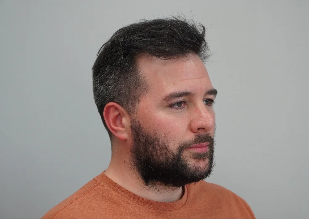 After hair restoration: Male patient underwent FUE procedure of 2115 grafts.