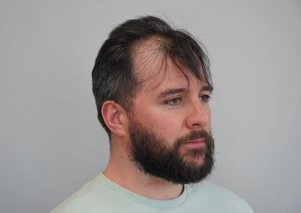 Before hair restoration: Male patient underwent FUE procedure of 2115 grafts.