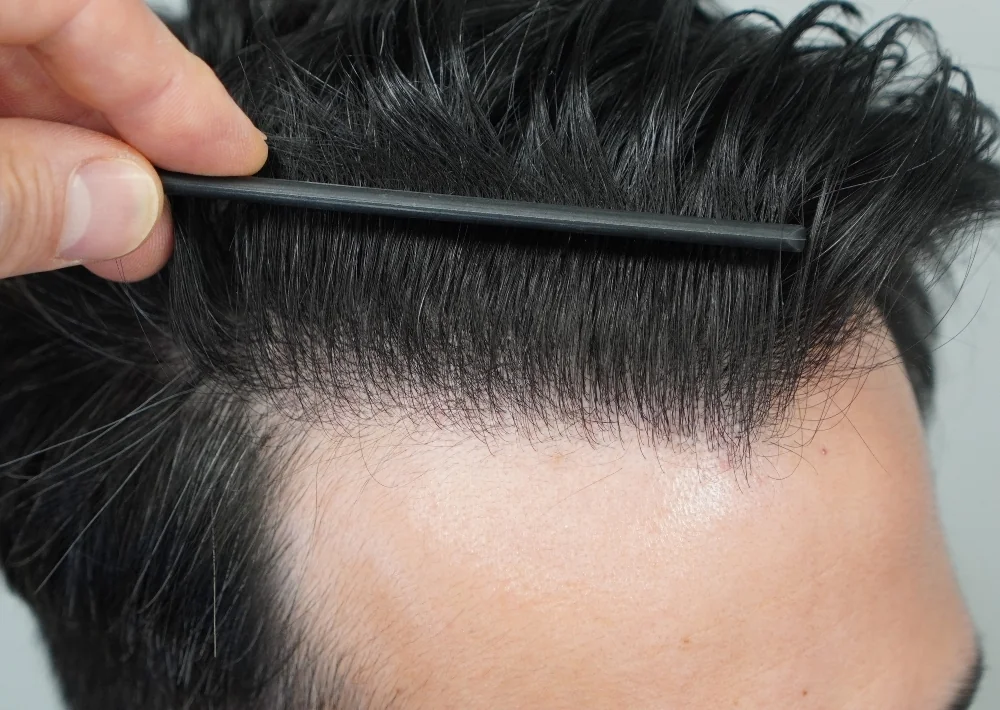 After hair restoration: Male patient underwent FUE procedure of 1186 grafts.