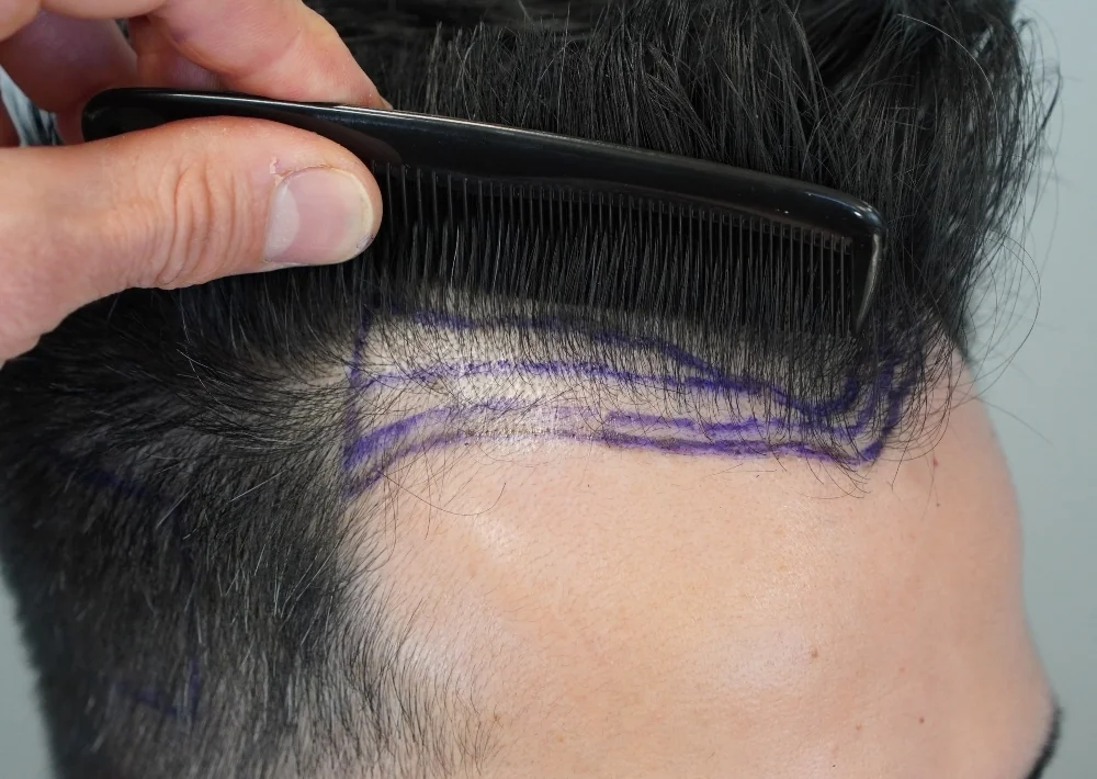 Before hair restoration: Male patient underwent FUE procedure of 1186 grafts.