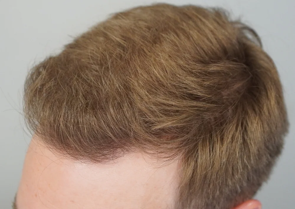 After hair restoration: Male patient underwent FUE procedure of 1826 grafts.