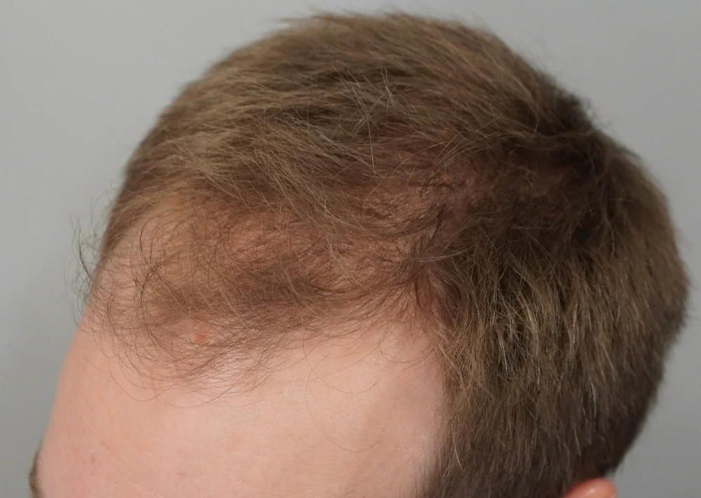 Before hair restoration: Male patient underwent FUE procedure of 1826 grafts.