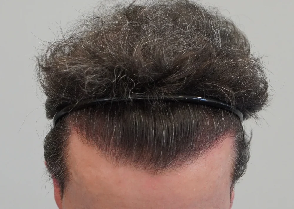 After hair restoration: Male patient underwent FUE procedure of 1694 grafts.