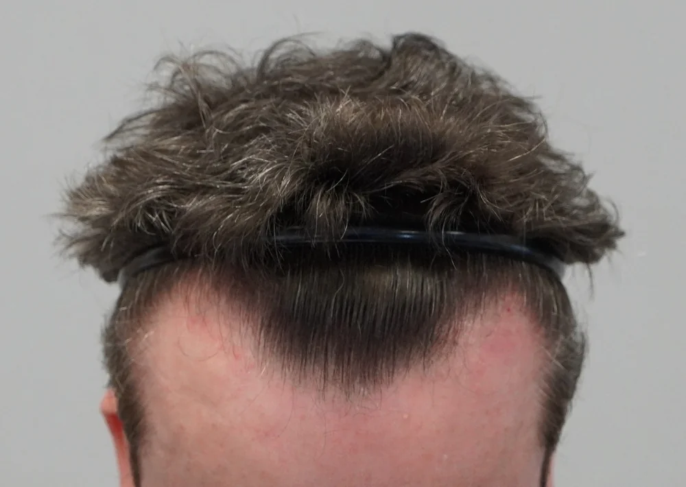 Before hair restoration: Male patient underwent FUE procedure of 1694 grafts.