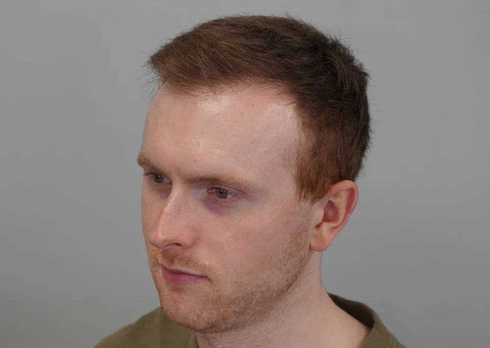 After hair restoration: Male patient underwent FUE procedure of 1717 grafts.