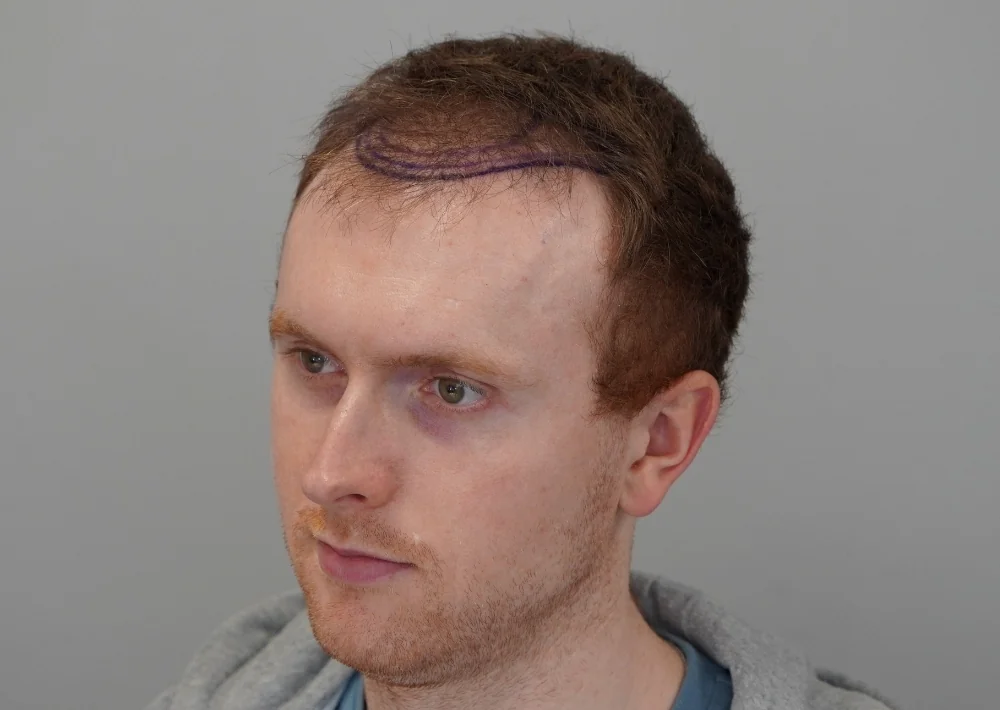 Before hair restoration: Male patient underwent FUE procedure of 1717 grafts.