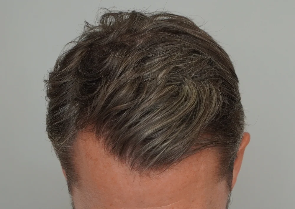After hair restoration: Male patient underwent FUE procedure of 1030 grafts.