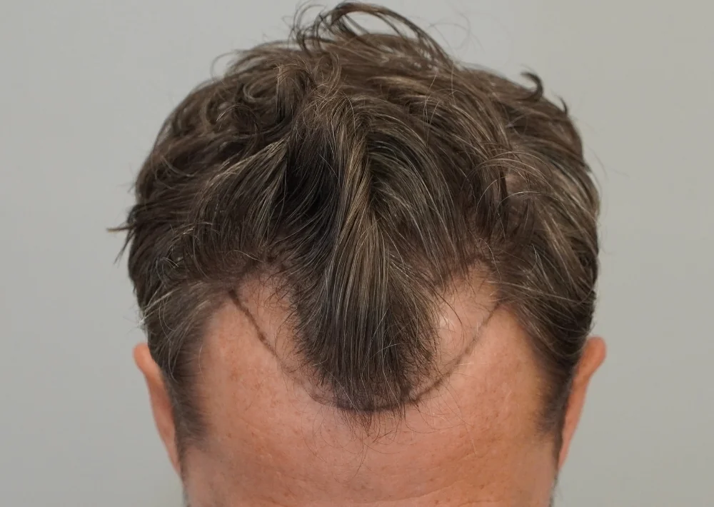 Before hair restoration: Male patient underwent FUE procedure of 1030 grafts.