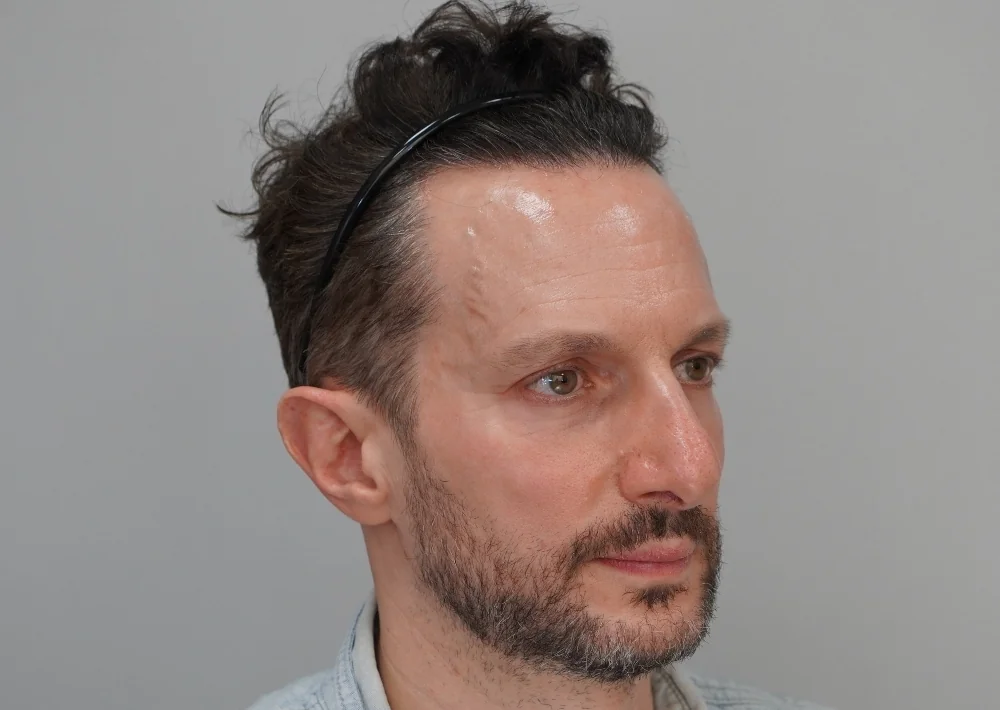 After hair restoration: Male patient underwent FUE procedure of 1786 grafts.