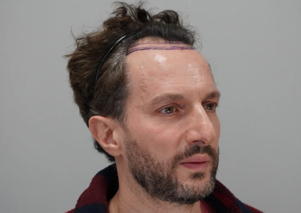 Before hair restoration: Male patient underwent FUE procedure of 1786 grafts.