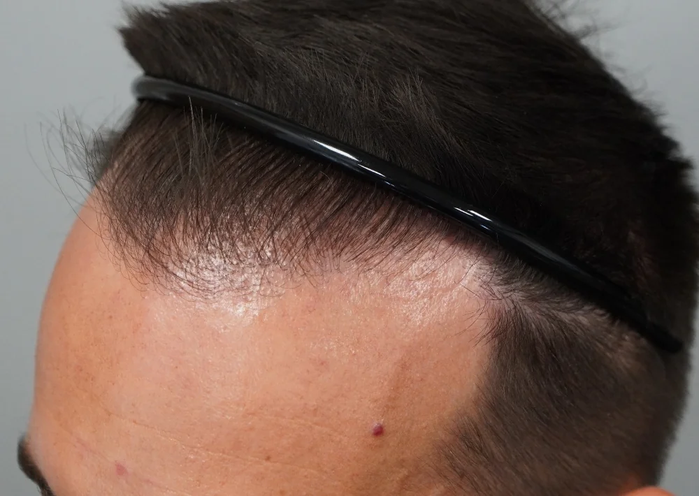 After hair restoration: Male patient underwent a repair procedure of 949 grafts.