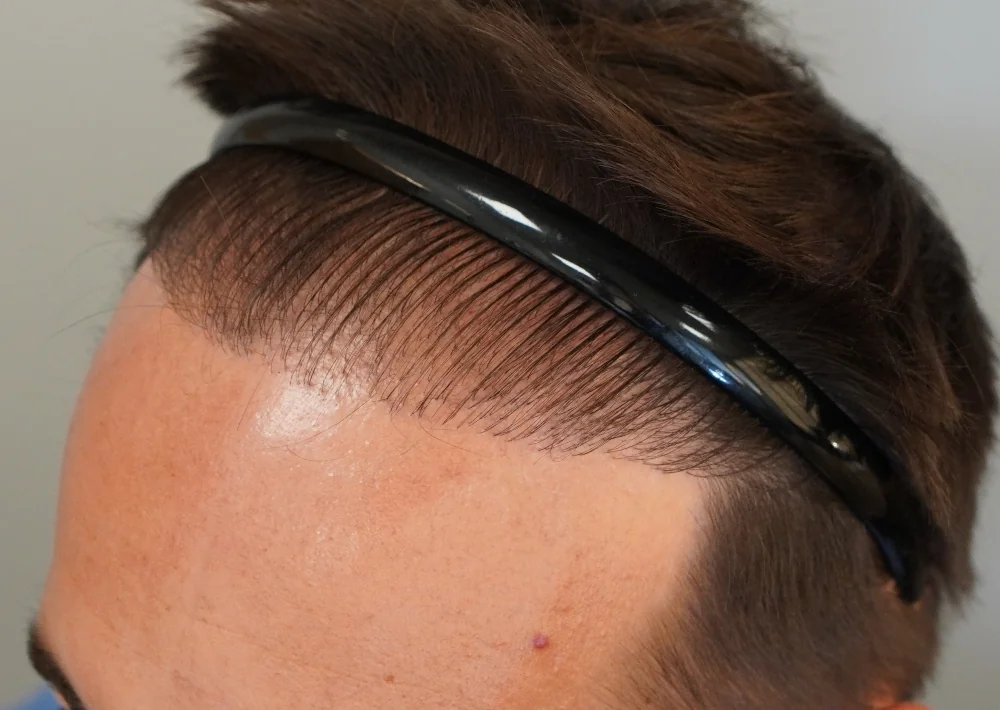 Before hair restoration: Male patient underwent a repair procedure of 949 grafts.