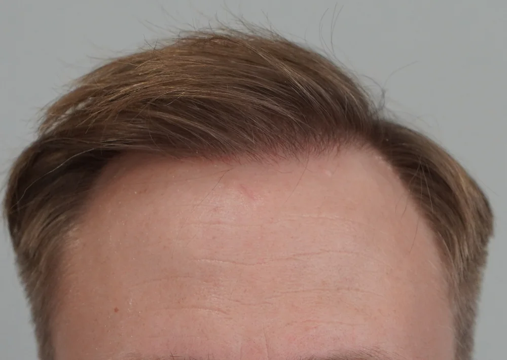 After hair restoration: Male patient underwent FUE procedure of 4566 grafts.