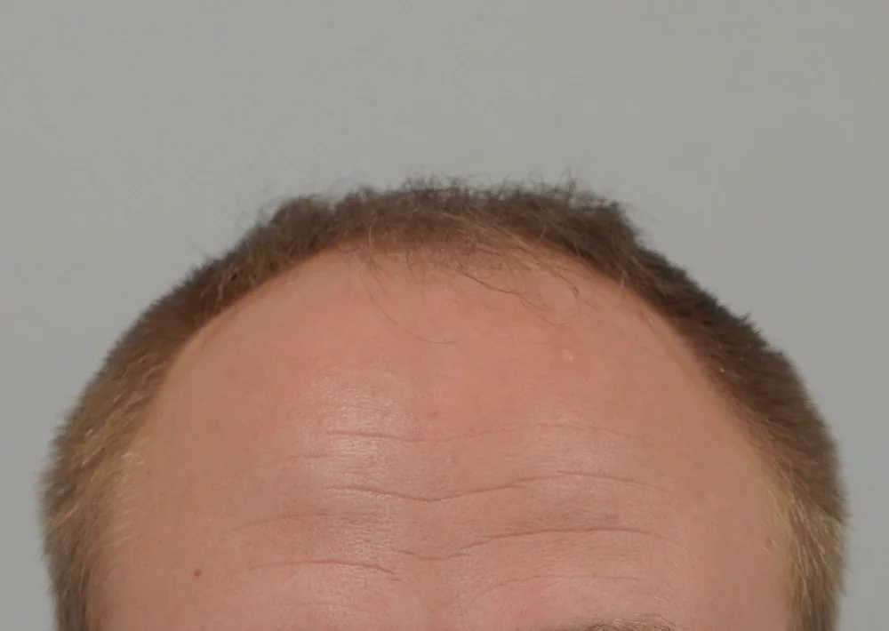 Before hair restoration: Male patient underwent FUE procedure of 4566 grafts.