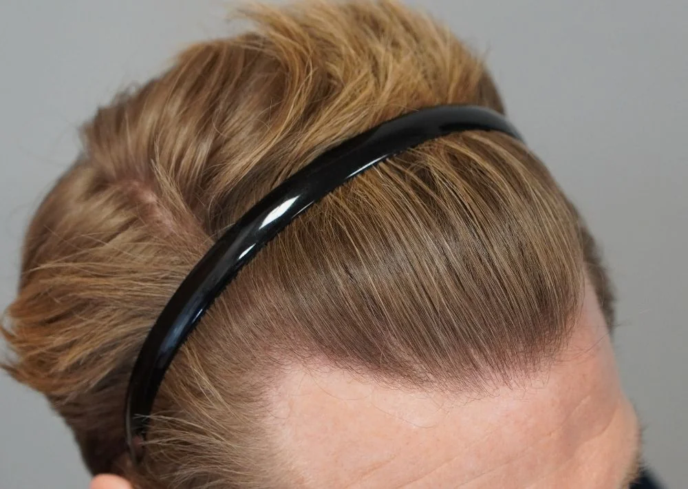 After hair restoration: Male patient underwent FUE procedure of 1956 grafts.