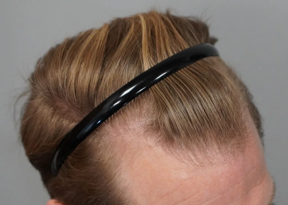 Before hair restoration: Male patient underwent FUE procedure of 1956 grafts.
