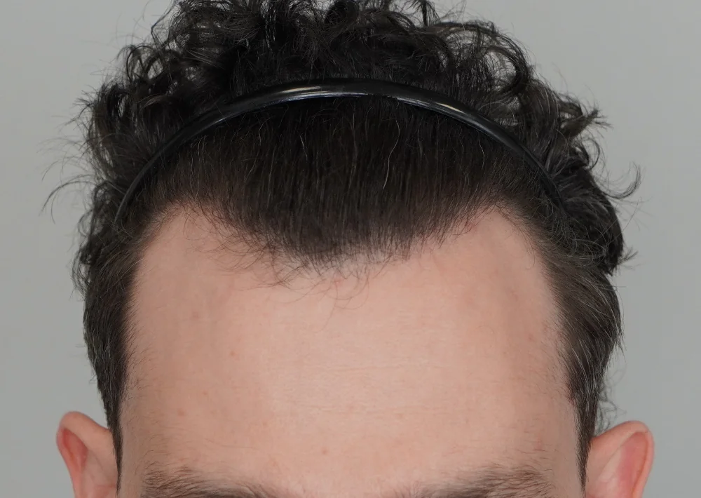 After hair restoration: Male patient underwent FUE procedure of 1801 grafts.