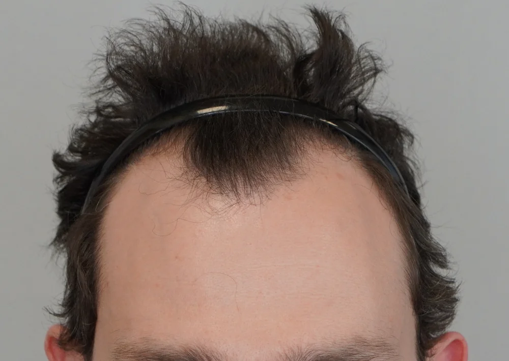 Before hair restoration: Male patient underwent FUE procedure of 1801 grafts.