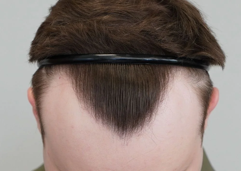 After hair restoration: Male patient underwent FUE procedure of 1406 grafts.