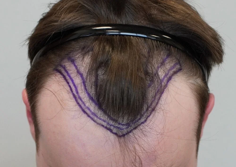 Before hair restoration: Male patient underwent FUE procedure of 1406 grafts.