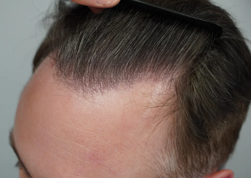 After hair restoration: Male patient underwent FUE procedure of 2023 grafts.