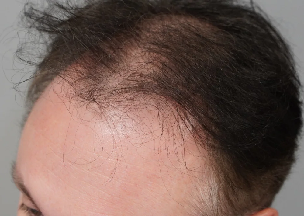 Before hair restoration: Male patient underwent FUE procedure of 2023 grafts.