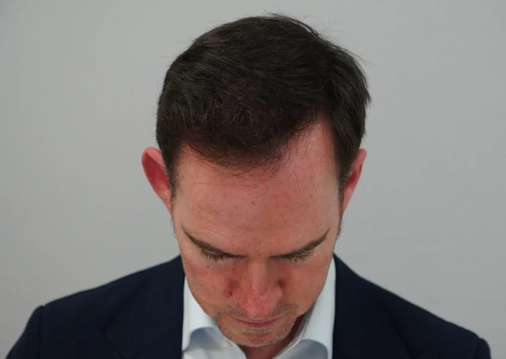 After hair restoration: Male patient underwent FUE procedure of 1432 grafts.