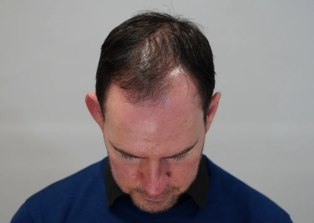 Before hair restoration: Male patient underwent FUE procedure of 1432 grafts.