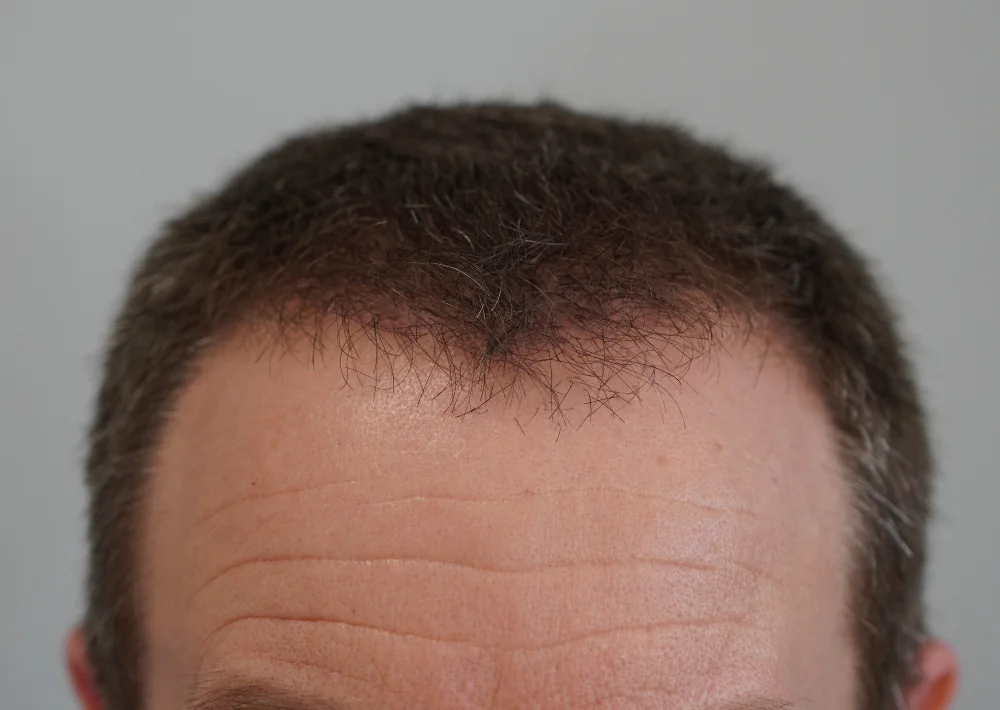 After hair restoration: Male patient underwent FUE procedure of 1603 grafts.