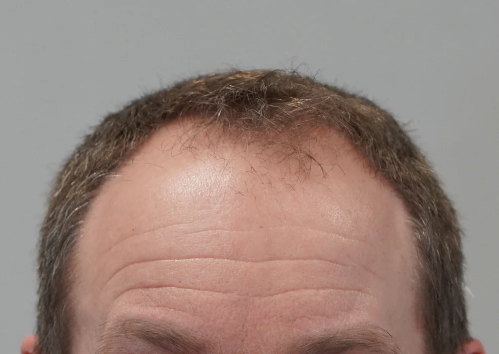 Before hair restoration: Male patient underwent FUE procedure of 1603 grafts.