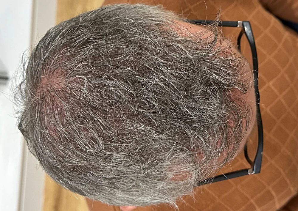 After hair restoration: Male patient underwent FUT procedure of 2448 grafts.