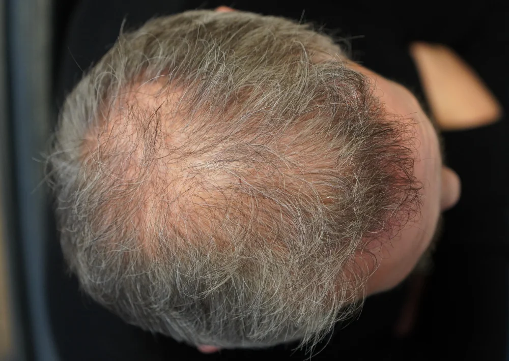 Before hair restoration: Male patient underwent FUT procedure of 2448 grafts.