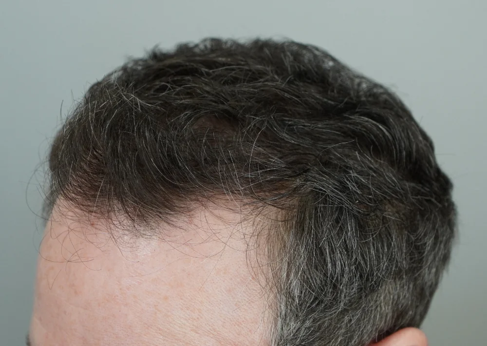 After hair restoration: Male patient underwent FUE procedure of 2560 grafts.