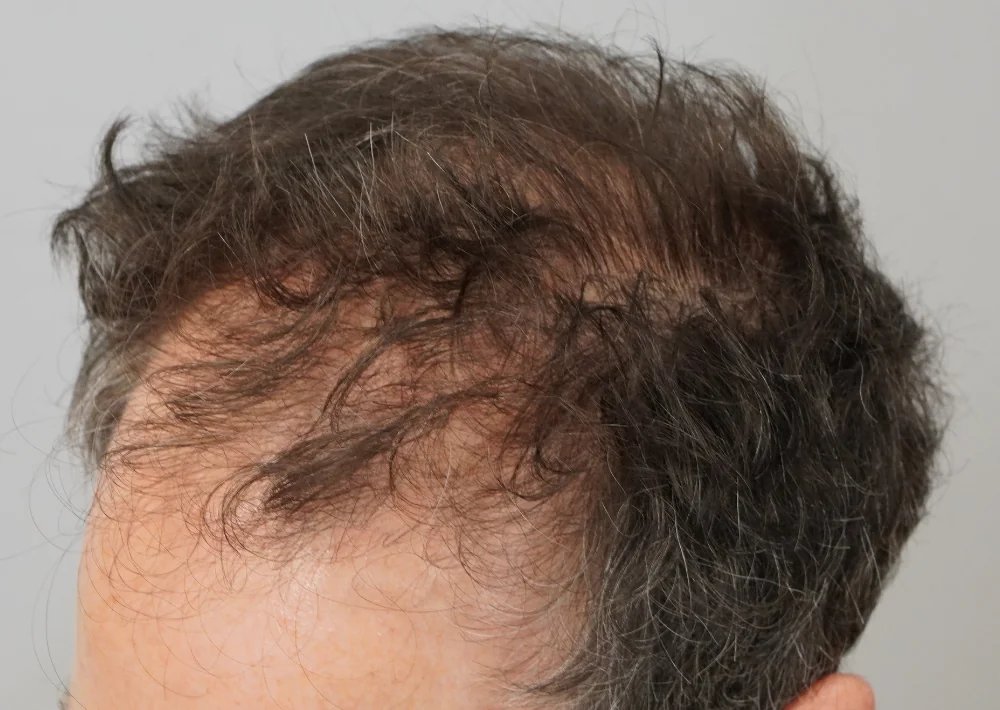 Before hair restoration: Male patient underwent FUE procedure of 2560 grafts.