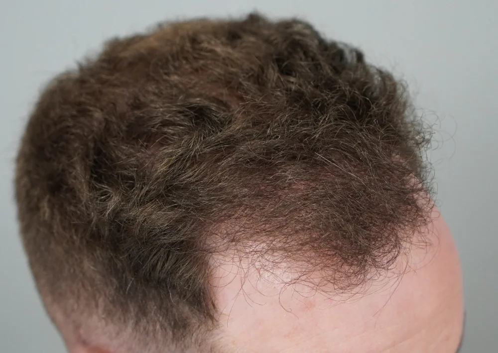 After hair restoration: Male patient underwent FUE procedure of 1637 grafts.
