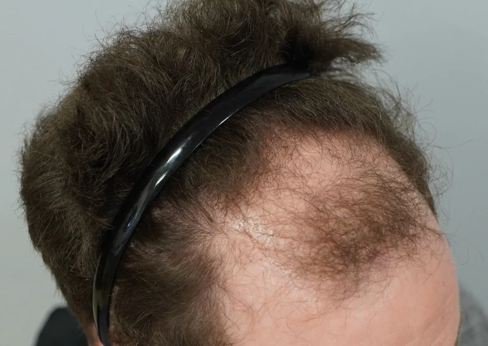 Before hair restoration: Male patient underwent FUE procedure of 1637 grafts.
