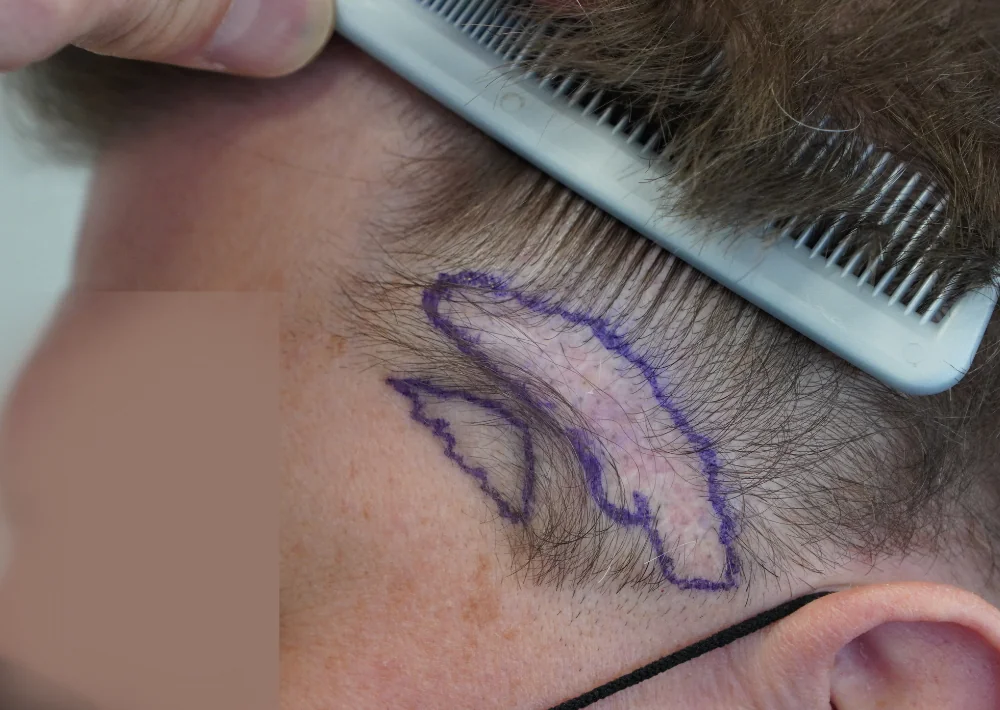 Before hair restoration: Male patient underwent FUE procedure of 237 grafts.