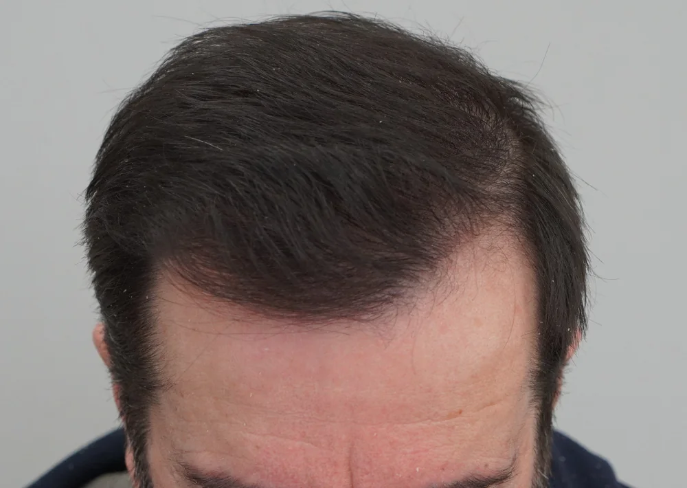 After hair restoration: Male patient underwent FUT procedure of 3803 grafts.