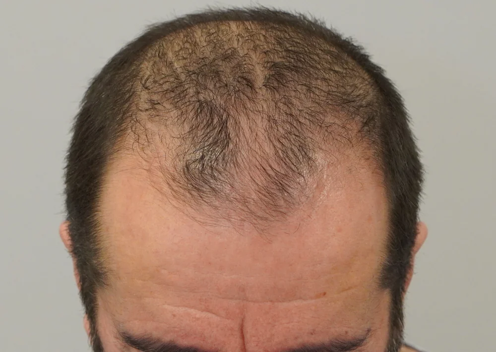 Before hair restoration: Male patient underwent FUT procedure of 3803 grafts.