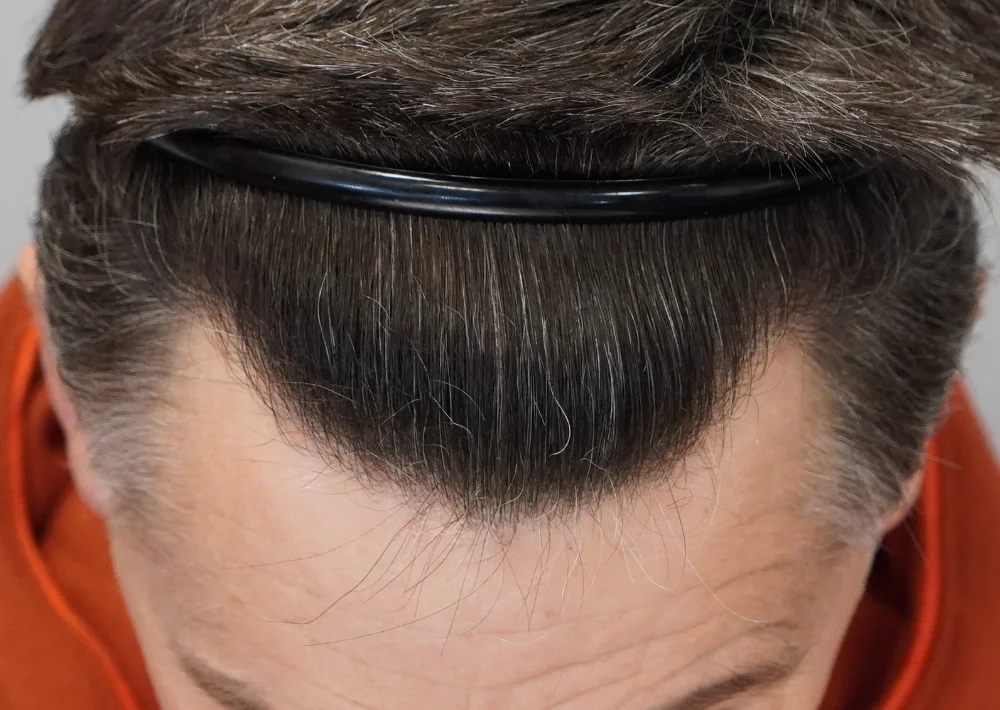 After hair restoration: Male patient underwent FUE procedure of 1357 grafts.