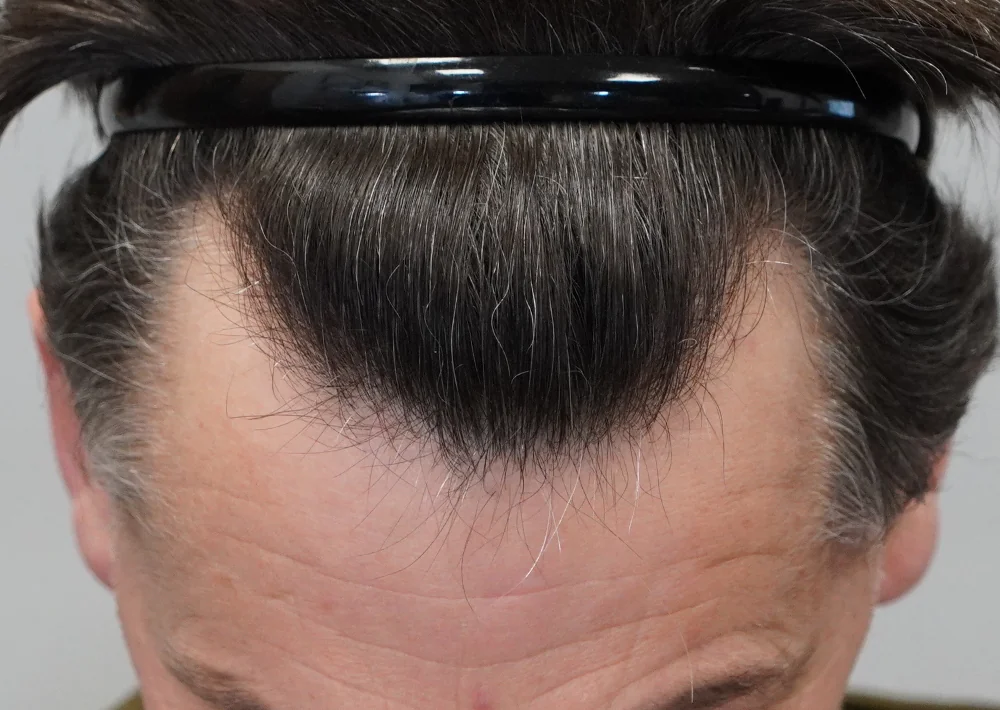 Before hair restoration: Male patient underwent FUE procedure of 1357 grafts.