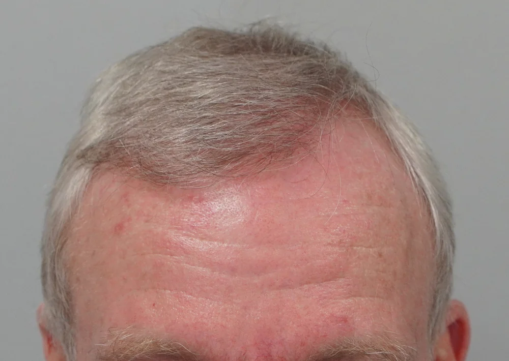 After hair restoration: Male patient underwent FUE procedure of 2122 grafts.