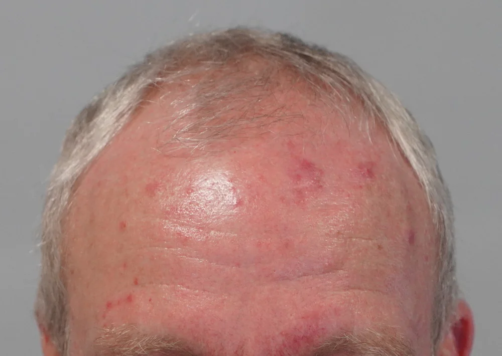 Before hair restoration: Male patient underwent FUE procedure of 2122 grafts.
